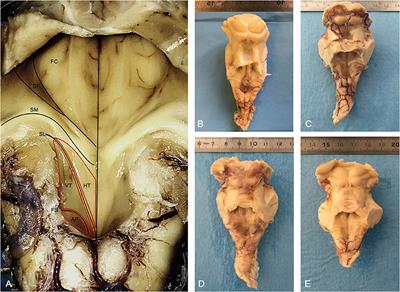 3D Reconstruction of the Morpho-Functional Topography of the Human Vagal Trigone